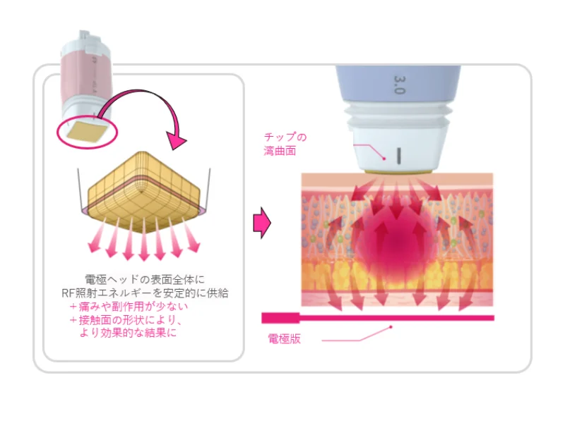 チップについて